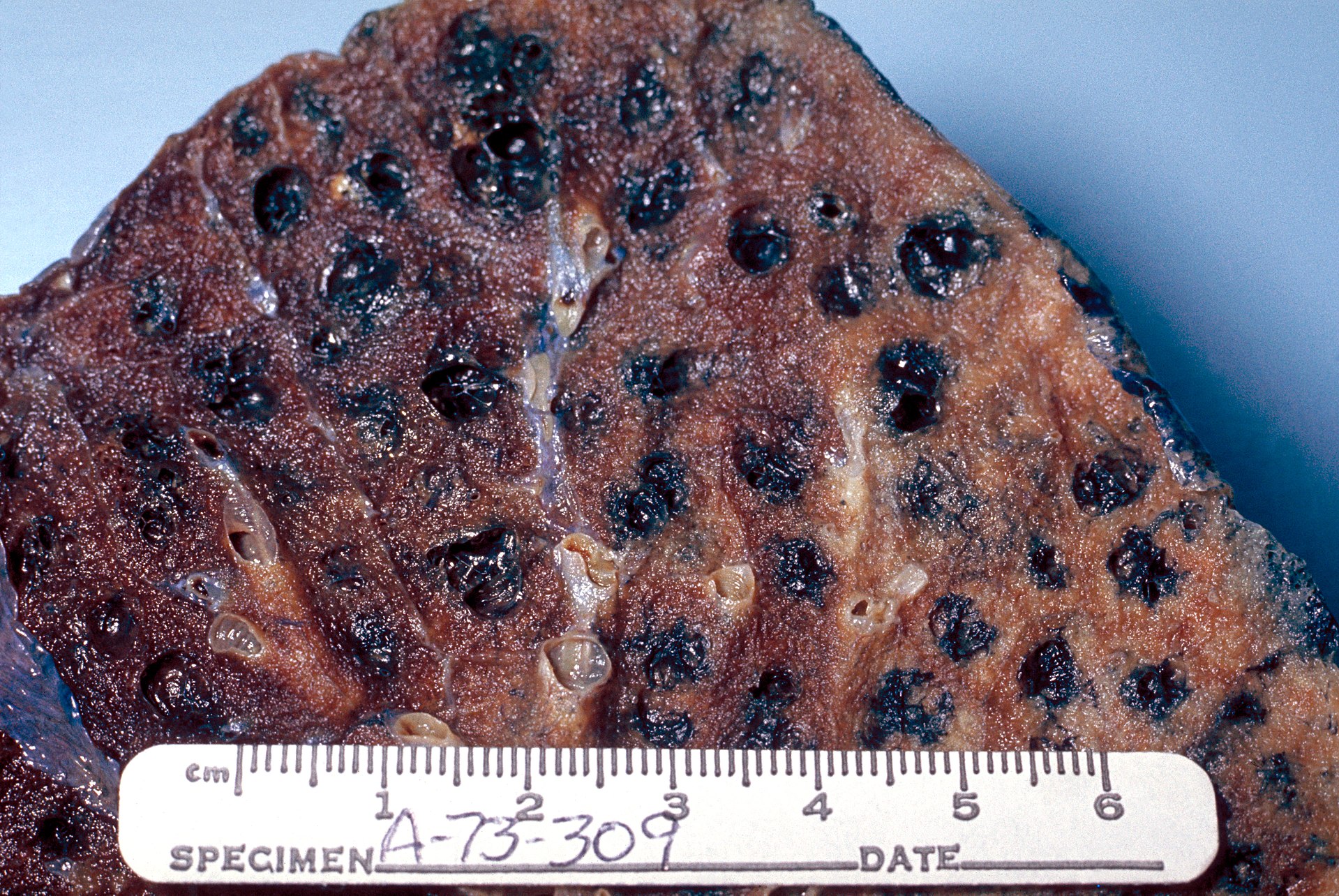 1920px-Centrilobular_emphysema_865_lores