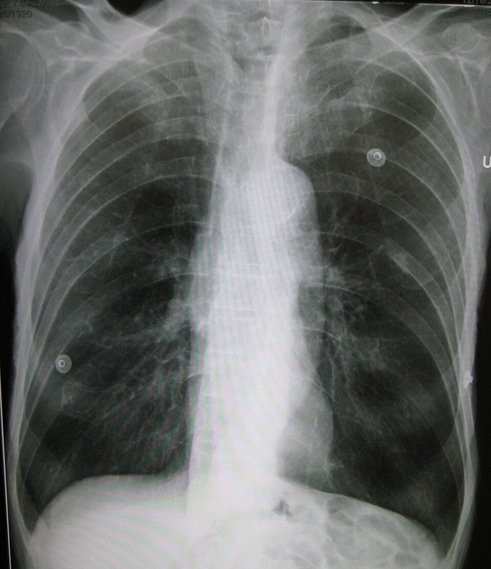 Emphysema2008 Emphysema2008